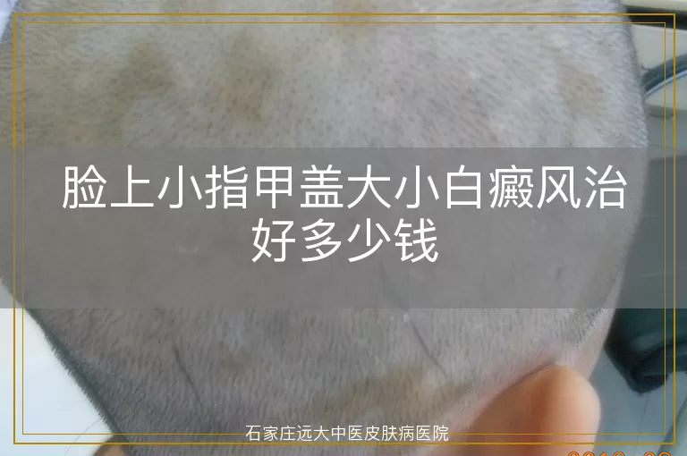 脸上小指甲盖大小白癜风治好多少钱