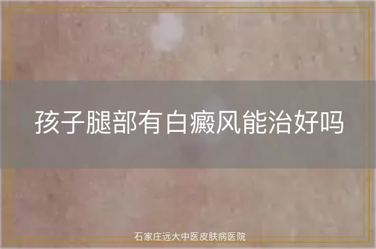 孩子腿部有白癜风能治好吗