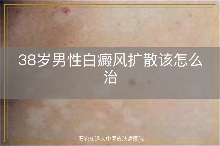 38岁男性白癜风扩散该怎么治