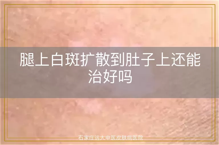 腿上白斑扩散到肚子上还能治好吗