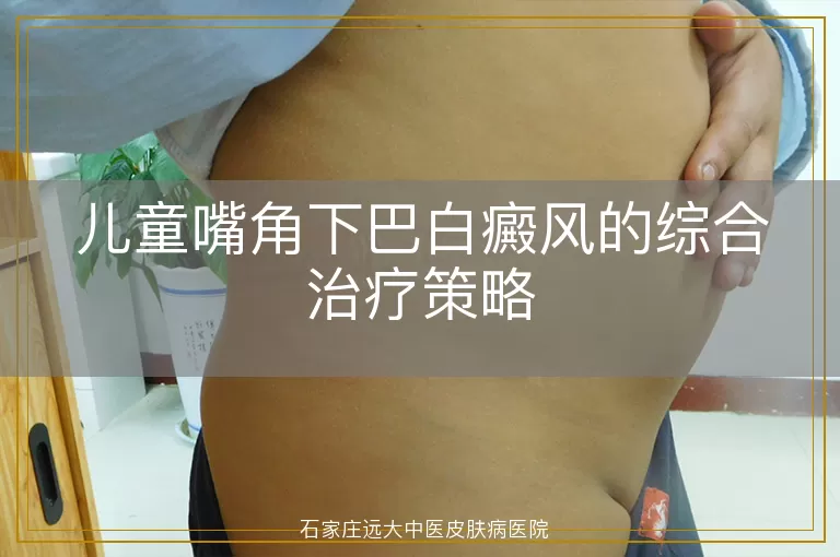 儿童嘴角下巴白癜风的综合治疗策略