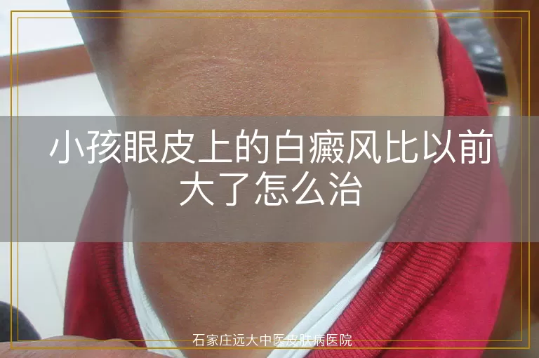 小孩眼皮上的白癜风比以前大了怎么治