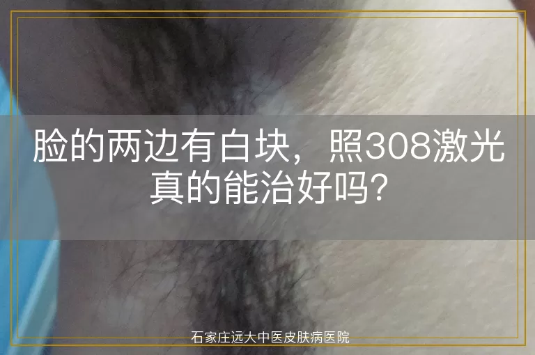 脸的两边有白块，照308激光真的能治好吗？