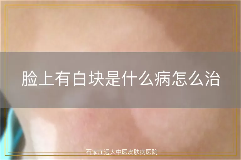 脸上有白块是什么病怎么治