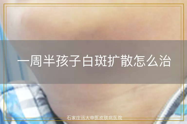 一周半孩子白斑扩散怎么治