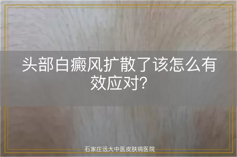 头部白癜风扩散了该怎么有效应对？