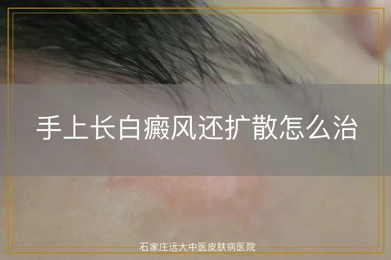 手上长白癜风还扩散怎么治