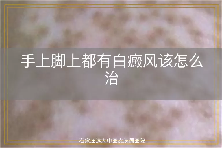 手上脚上都有白癜风该怎么治