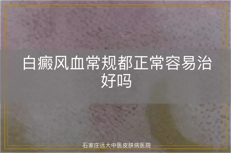 白癜风血常规都正常容易治好吗