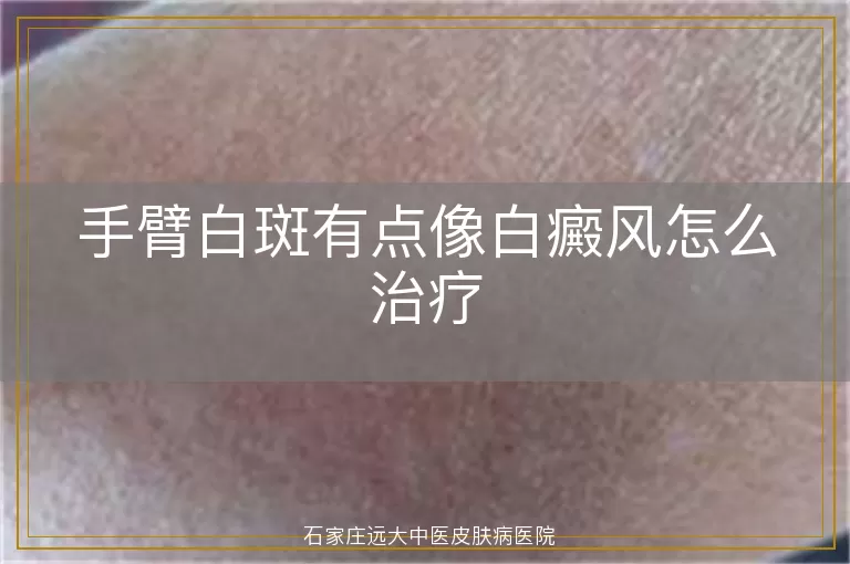 手臂白斑有点像白癜风怎么治疗