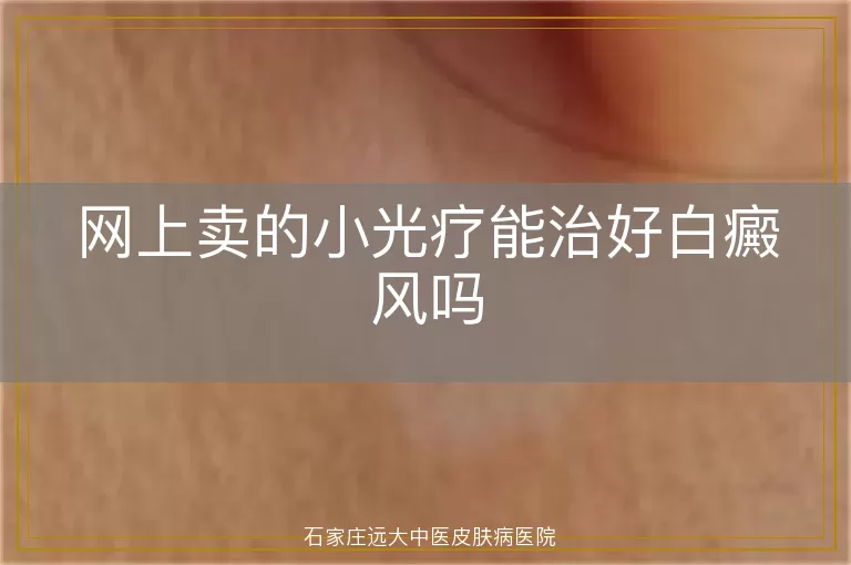 网上卖的小光疗能治好白癜风吗
