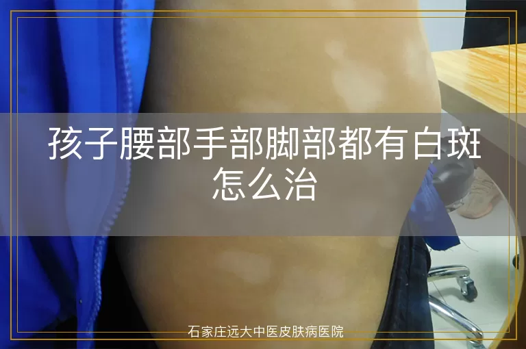 孩子腰部手部脚部都有白斑怎么治