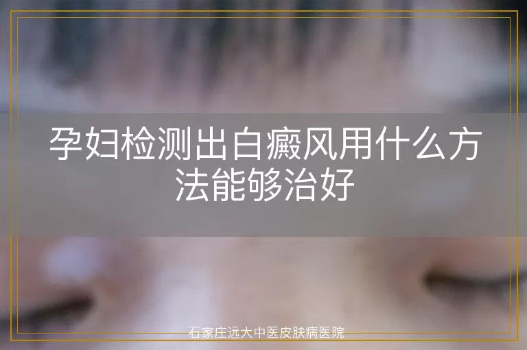 孕妇检测出白癜风用什么方法能够治好
