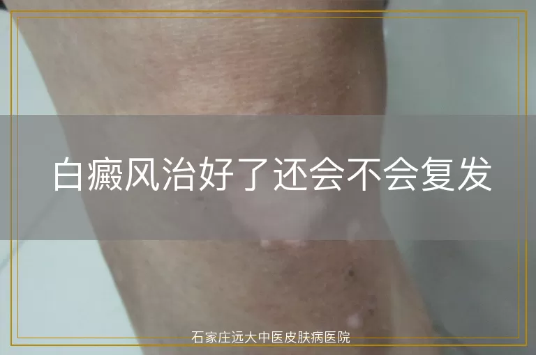 白癜风治好了还会不会复发