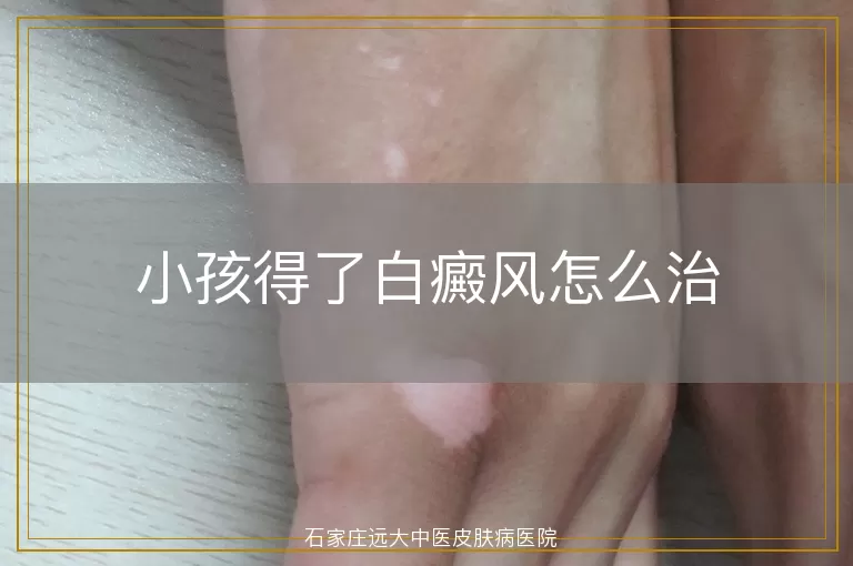 小孩得了白癜风怎么治