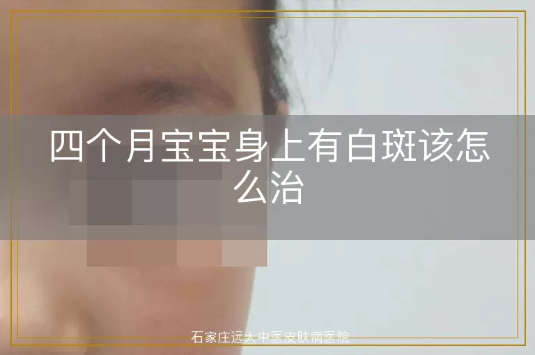 四个月宝宝身上有白斑该怎么治