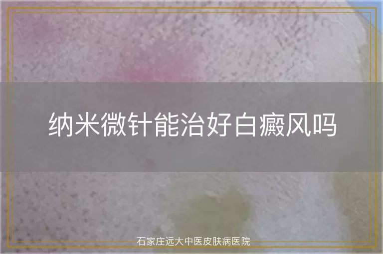 纳米微针能治好白癜风吗