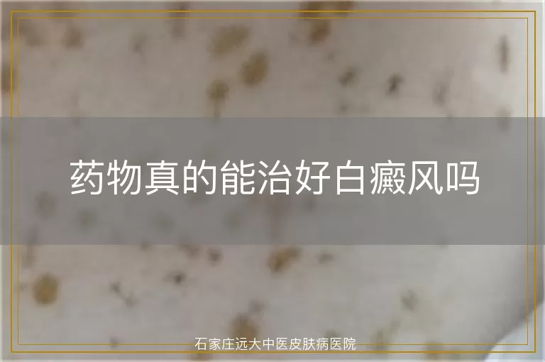 药物真的能治好白癜风吗