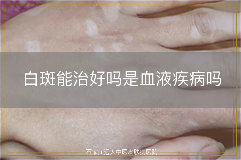 白斑能治好吗是血液疾病吗