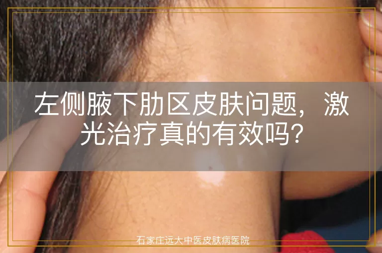 左侧腋下肋区皮肤问题，激光治疗真的有效吗？