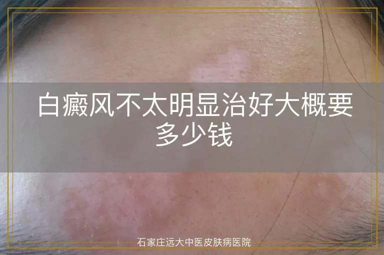 白癜风不太明显治好大概要多少钱
