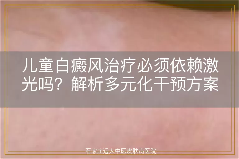 儿童白癜风治疗必须依赖激光吗?解析多元化干预方案