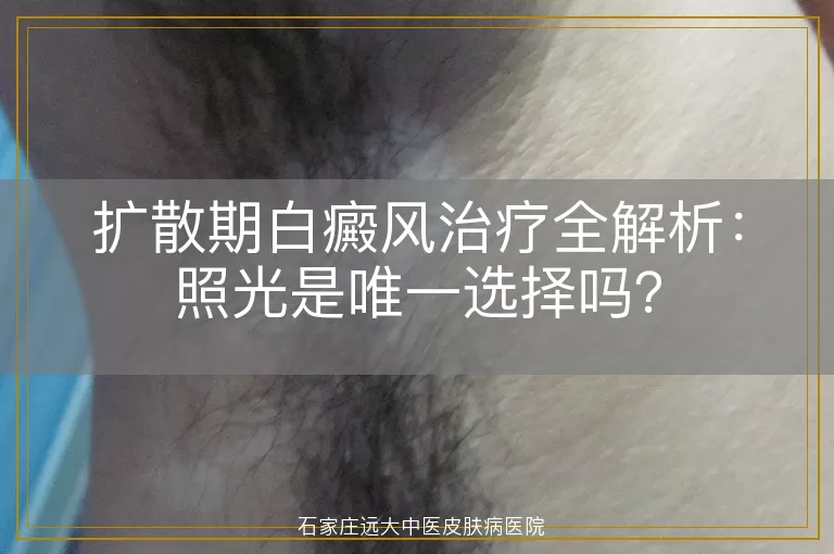 扩散期白癜风治疗全解析：照光是唯一选择吗？