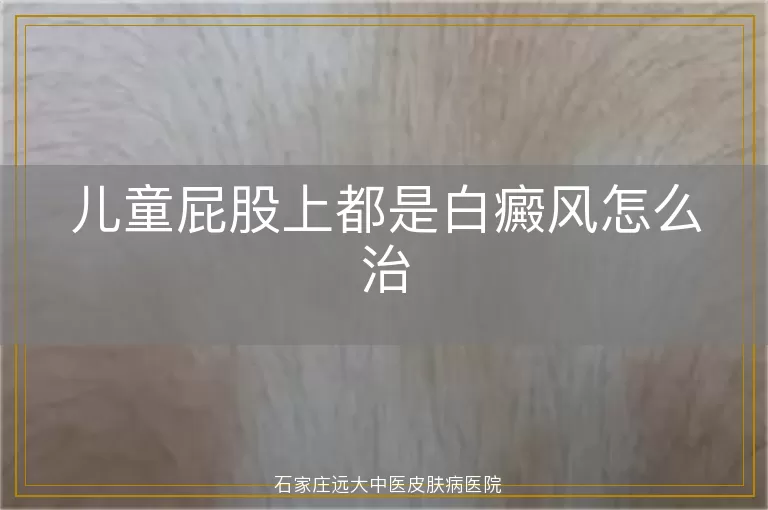 儿童屁股上都是白癜风怎么治