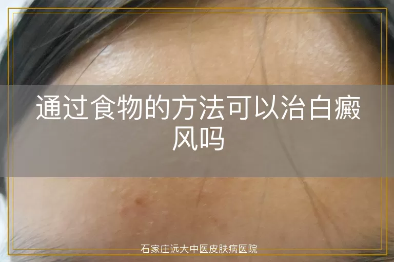 通过食物的方法可以治白癜风吗