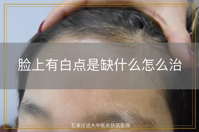 脸上有白点是缺什么怎么治