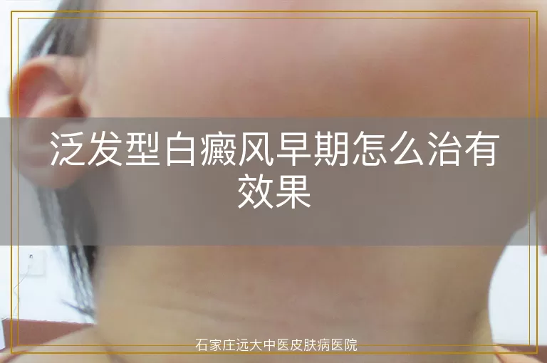 泛发型白癜风早期怎么治有效果