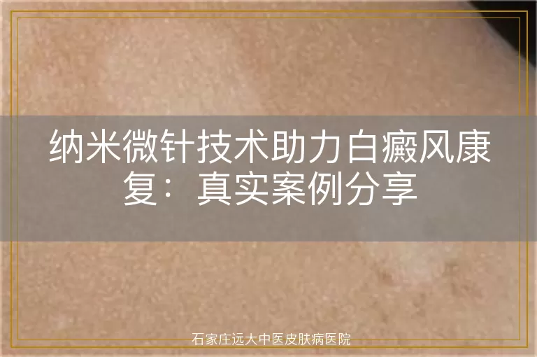 纳米微针技术助力白癜风康复：真实案例分享