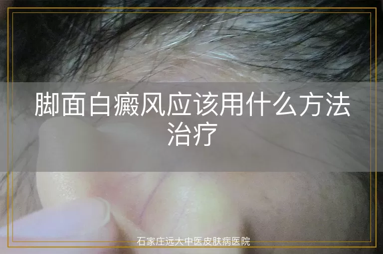 脚面白癜风应该用什么方法治疗