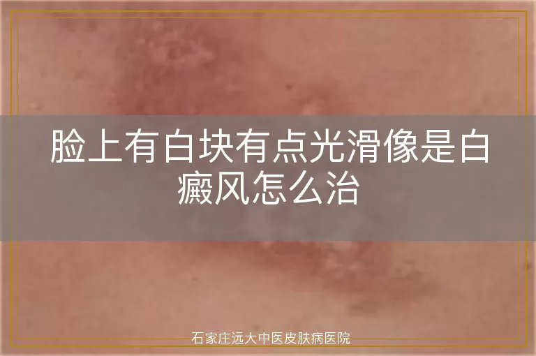 脸上有白块有点光滑像是白癜风怎么治