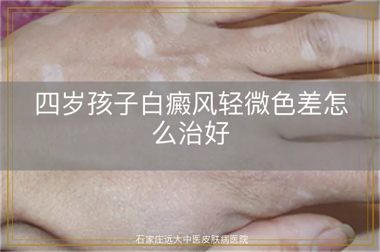 四岁孩子白癜风轻微色差怎么治好