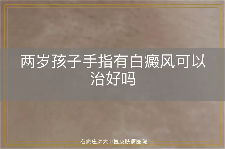 两岁孩子手指有白癜风可以治好吗