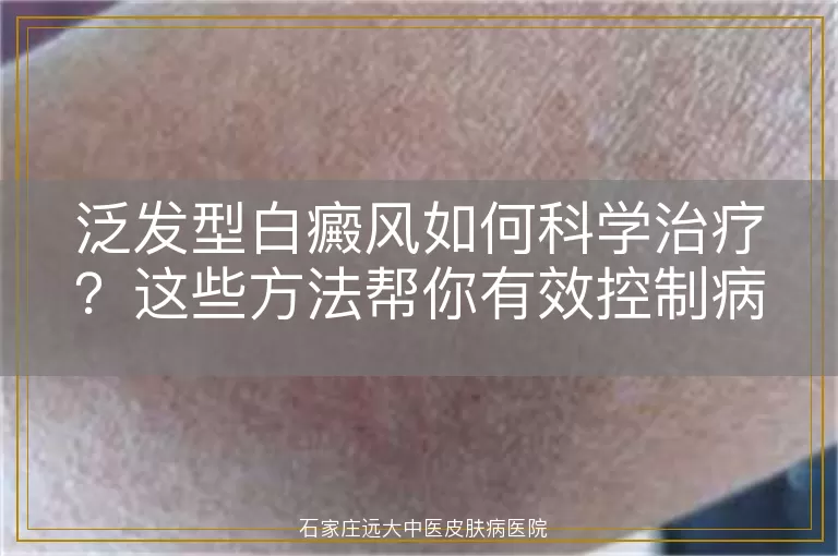 泛发型白癜风如何科学治疗?这些方法帮你有效控制病情