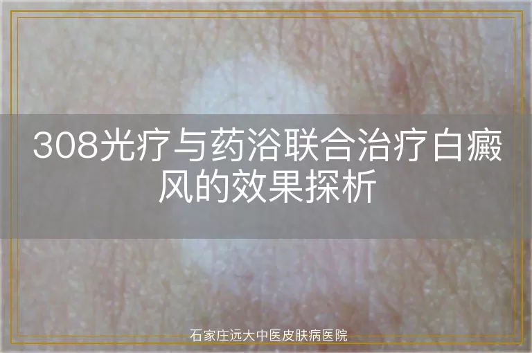 308光疗与药浴联合治疗白癜风的效果探析