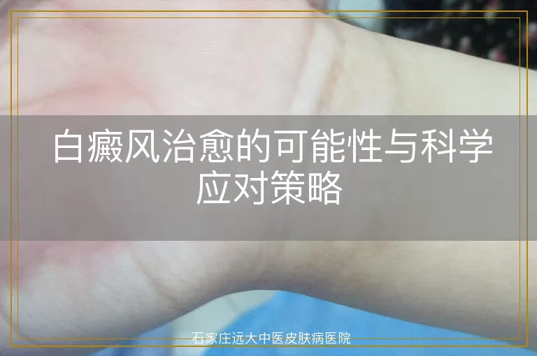 白癜风治愈的可能性与科学应对策略