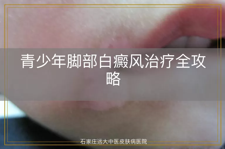 青少年脚部白癜风治疗全攻略