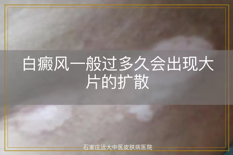 白癜风一般过多久会出现大片的扩散