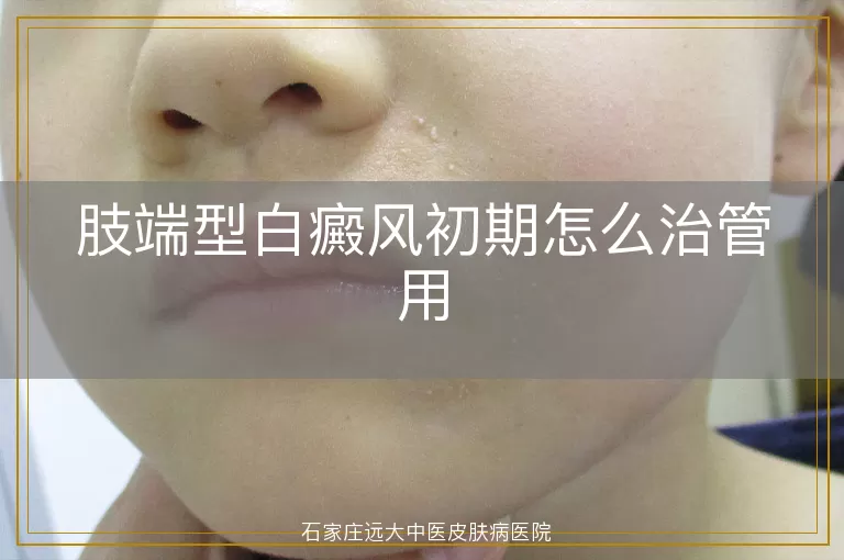 肢端型白癜风初期怎么治管用