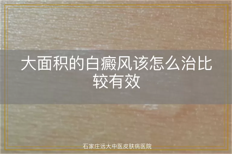 大面积的白癜风该怎么治比较有效
