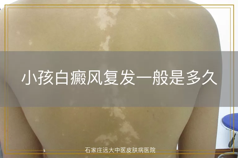 小孩白癜风复发一般是多久