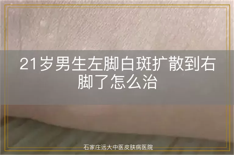 21岁男生左脚白斑扩散到右脚了怎么治