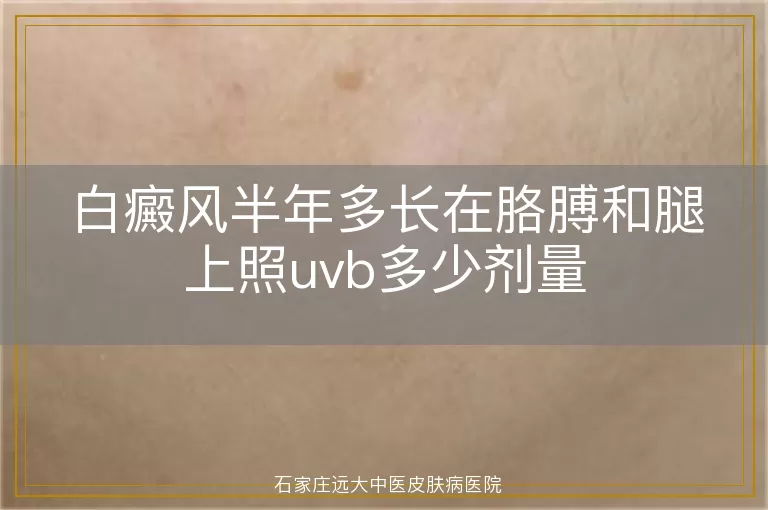 白癜风半年多长在胳膊和腿上照uvb多少剂量