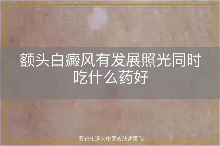 额头白癜风有发展照光同时吃什么药好