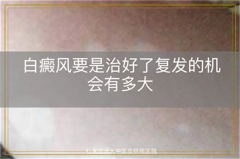 白癜风要是治好了复发的机会有多大