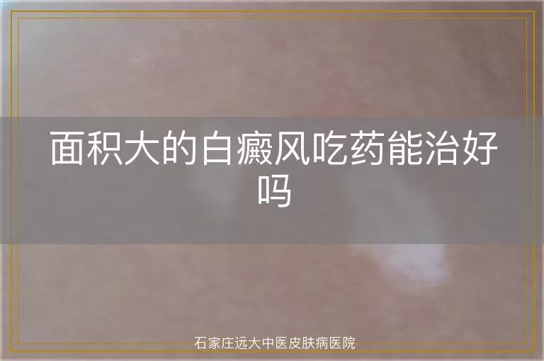 面积大的白癜风吃药能治好吗