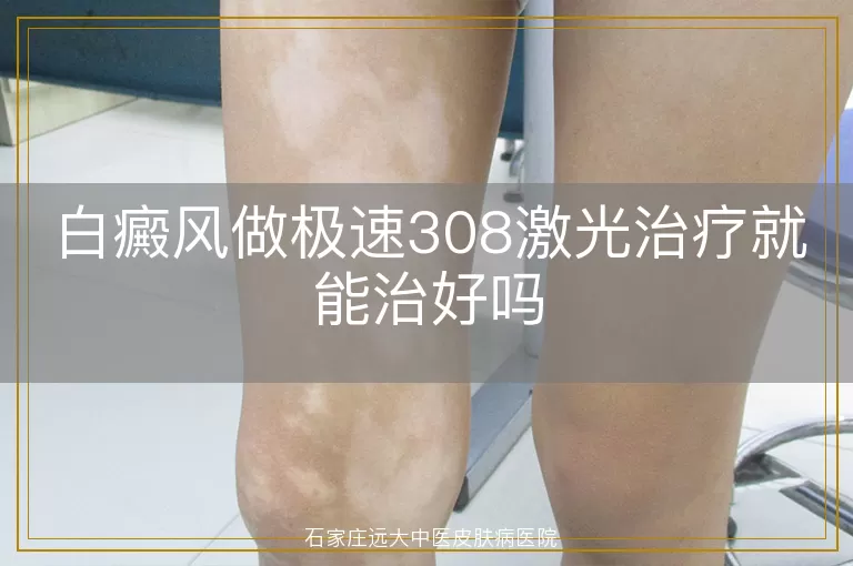 白癜风做极速308激光治疗就能治好吗